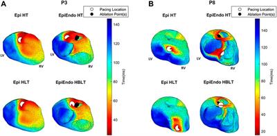 Comparison of dipole-based and potential-based ECGI methods for premature ventricular contraction beat localization with clinical data